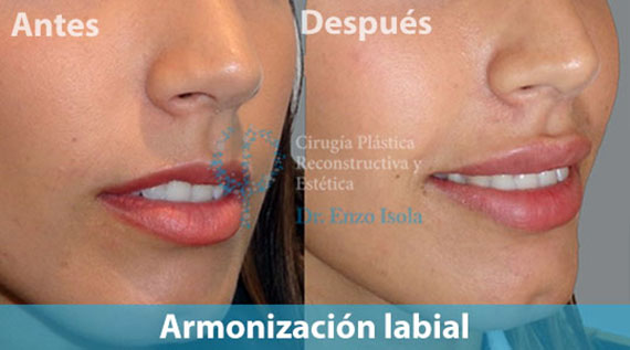 Armonización labial