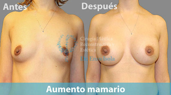 Aumento mamario