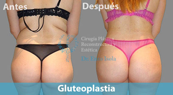 Gluteoplastia