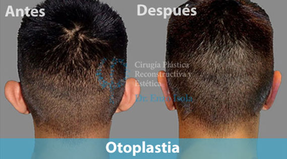 Otoplastia