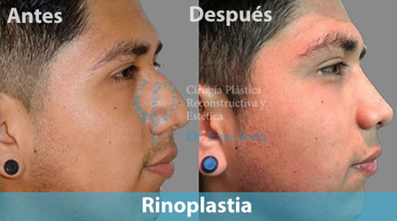 Rinoplastia
