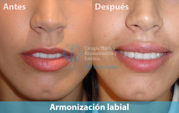 Antes y después del procedimiento estético de Armonización labial