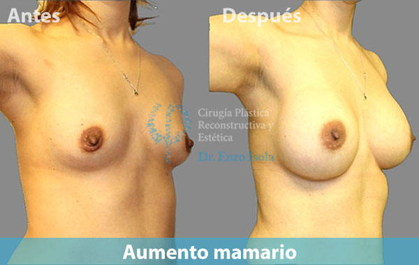 Antes y después del procedimiento estético de Aumento mamario