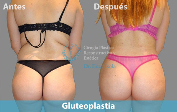 Antes y después del procedimiento estético de Gluteoplastia