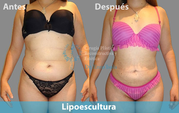 Antes y después del procedimiento estético de Lipoescultura