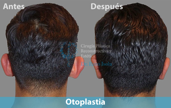 Antes y después del procedimiento estético de Otoplastia