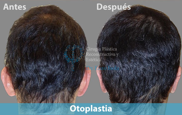 Antes y después del procedimiento estético de Otoplastia