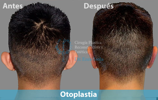 Antes y después del procedimiento estético de Otoplastia