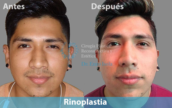 Antes y después del procedimiento estético de Rinoplastia