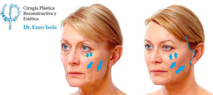 Lifting facial - Preparación pre-operatoria