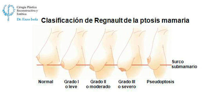 Mastopexia - Preparación pre-operatoria