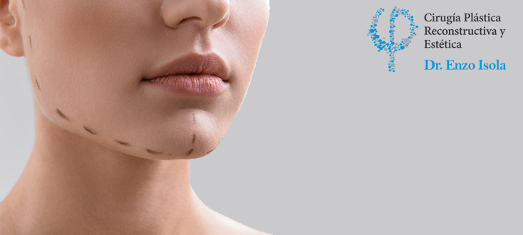 Mentoplastia - Preparación pre-operatoria