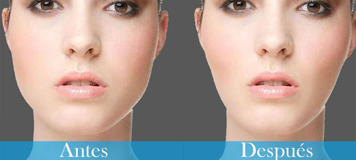 Bichectomia - Post-operatorio