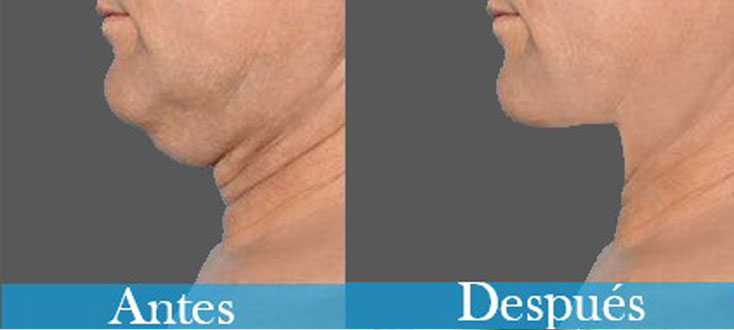 Lifting de cuello - Post-operatorio