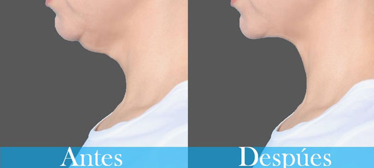 Lifting de cuello - Post-operatorio