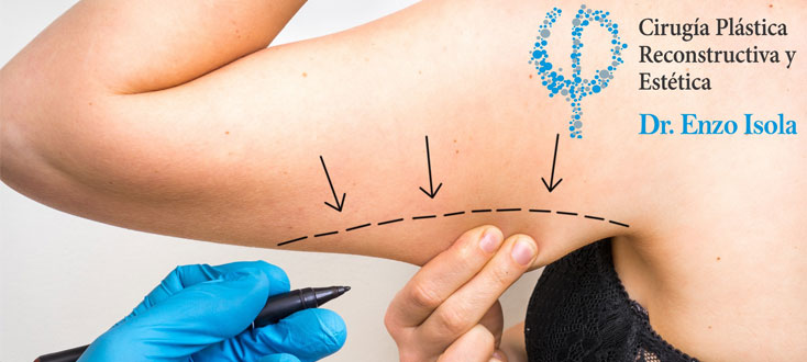 Braquioplastia - La operación