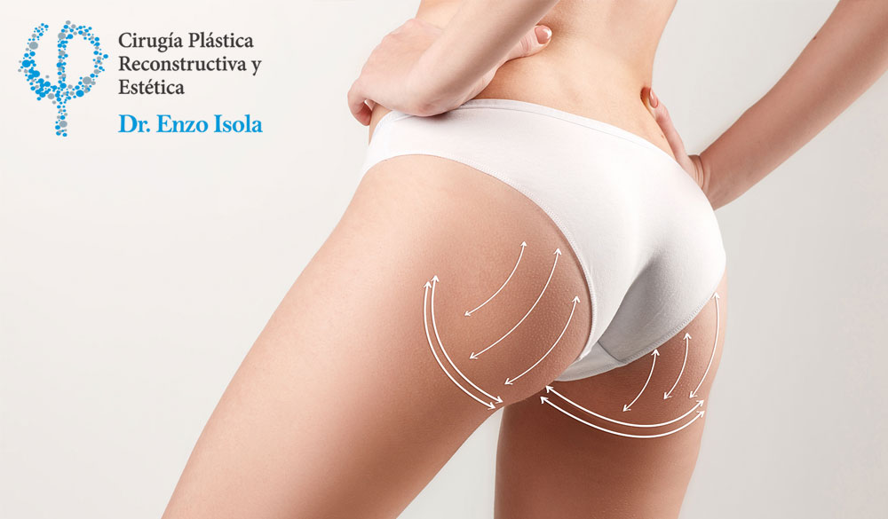 Cirugía Estética Glútea