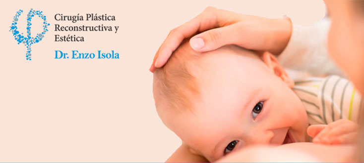 Cirugía Estética Mamaria: Levantamiento de mamas