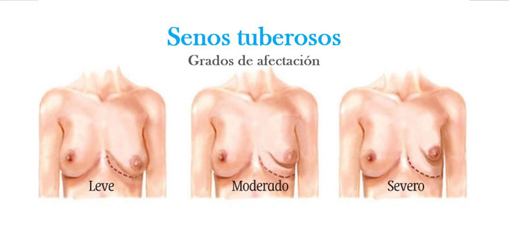 Senos tuberosos - Objetivos