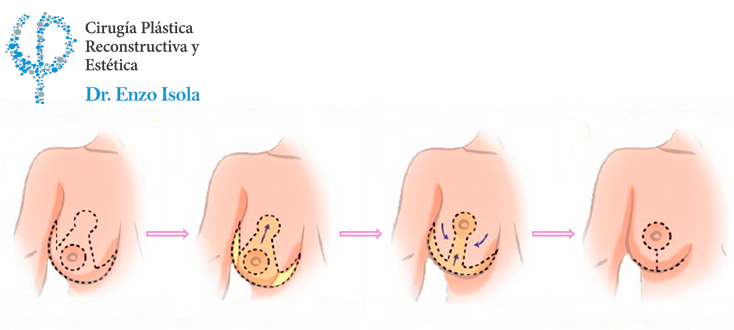 Reducción mamaria - Preparación pre-operatoria